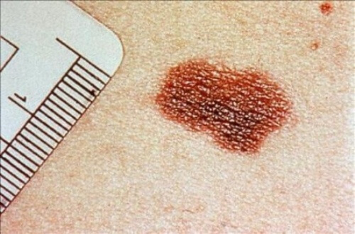 Tumore della pelle: segnali da non sottovalutare