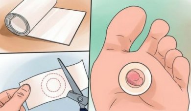 9 rimedi per curare le vesciche ai piedi