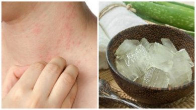 Orticaria colinergica e rimedi naturali
