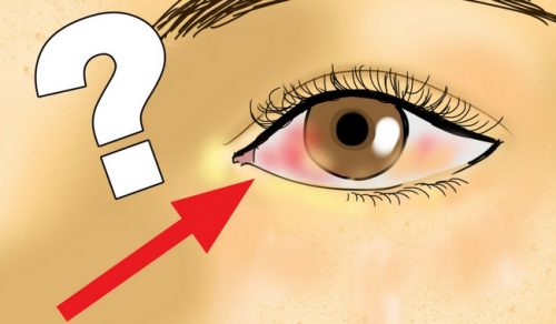 Il Retinoblastoma