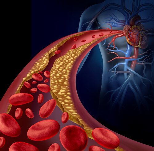arteriosclerosi a causa dell'opertensione