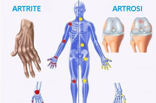 Differenza tra osteoporosi, artrosi e artrite