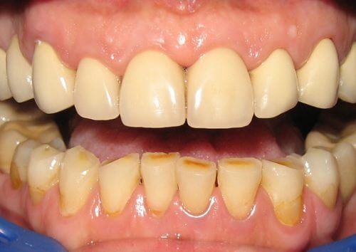 10 modi di eliminare la placca dentale in modo naturale