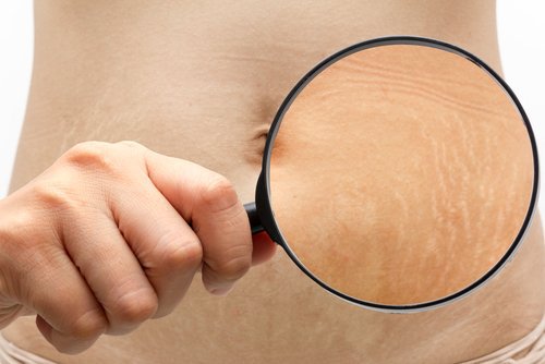 6 trucchi per migliorare l'aspetto delle smagliature