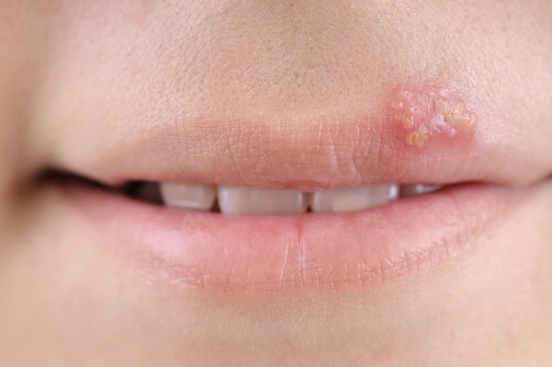 Herpes sulle labbra: come trattarlo con i rimedi naturali