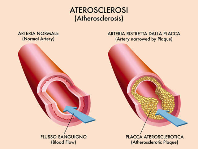 Arteria sana e con problemi