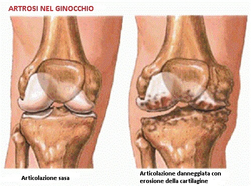 artrosi alle ginocchia