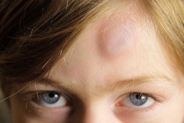 Lividi: 9 metodi naturali per trattarli