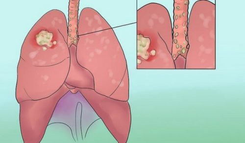 8 sintomi del tumore al polmone da non ignorare