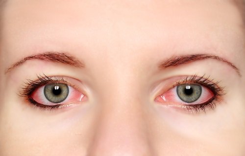 Congiuntivite da stress visivo