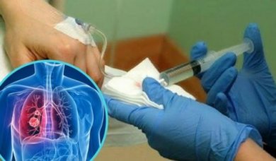 Ridurre gli effetti collaterali della chemioterapia nel tumore al polmone