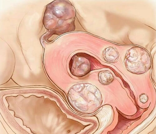 Fibroma uterino