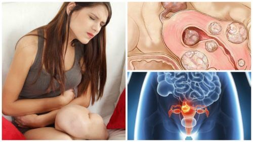 5 dati da conoscere sul fibroma uterino