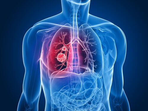 Ridurre gli effetti collaterali della chemioterapia del tumore al polmone