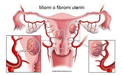 Fibroma uterino: 7 segnali d'allarme