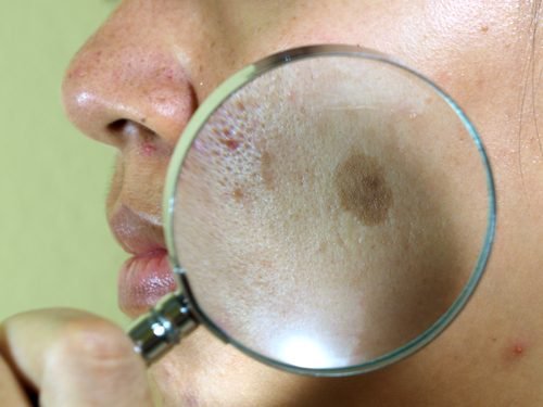 Trattamenti per il cloasma, anche noto come melasma