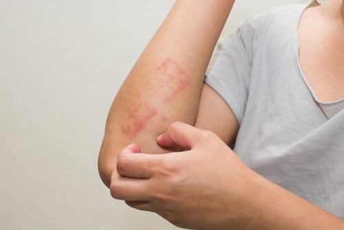 Braccio con psoriasi