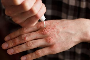 Trattare la psoriasi: 6 creme naturali