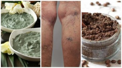 Eliminare le vene varicose con 6 rimedi naturali