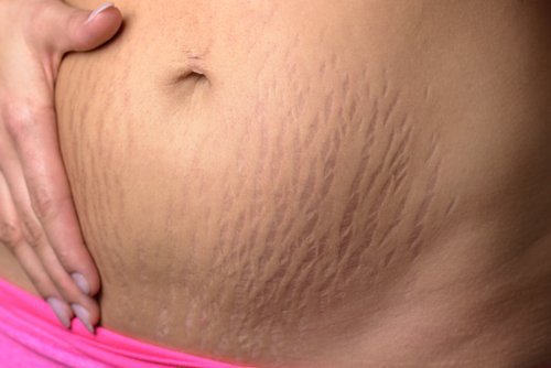 11 alimenti per ridurre le smagliature 11 alimenti per ridurre le smagliature