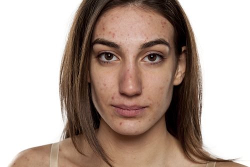 Vicks Vaporub per ridurre l’acne, un potente rimedio