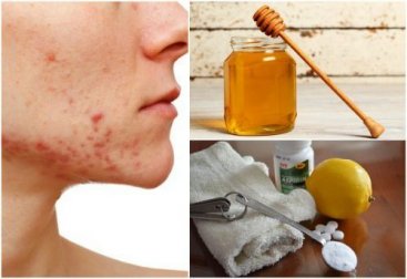6 rimedi naturali contro l'acne cistica