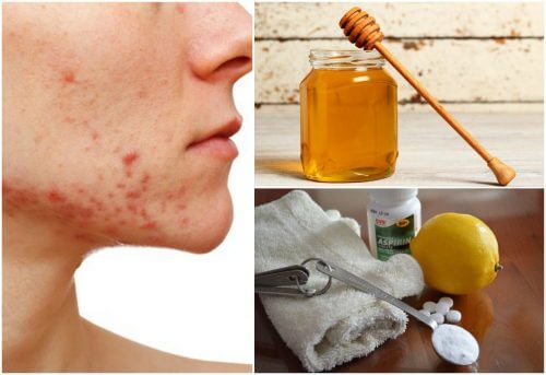 6 rimedi naturali contro l’acne cistica
