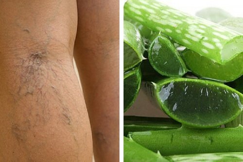 Aloe vera e vene varicose