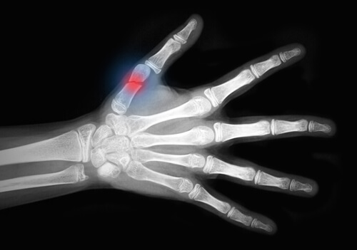 come prevenire l'osteoporosi