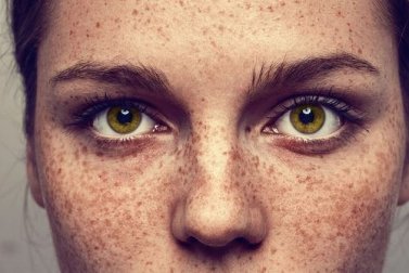 Eliminare le efelidi in modo naturale