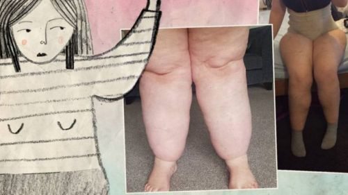 Lipedema
