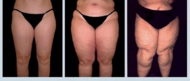 Lipedema: una malattia difficile e poco conosciuta