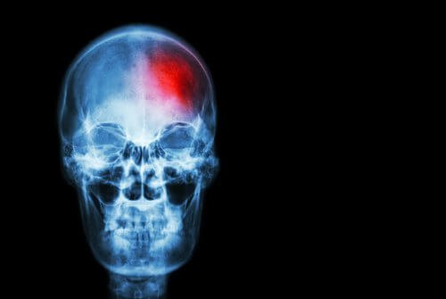 accidente cerebrovascolare