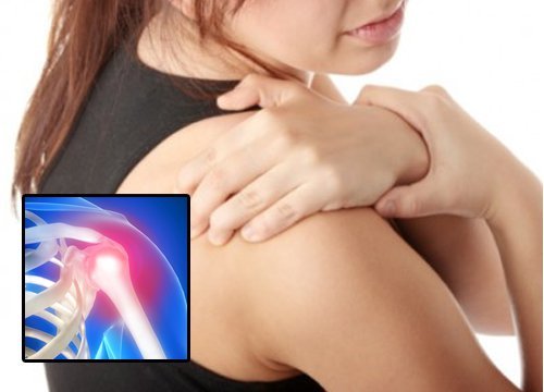 donna con capsulite articolare alla spalla
