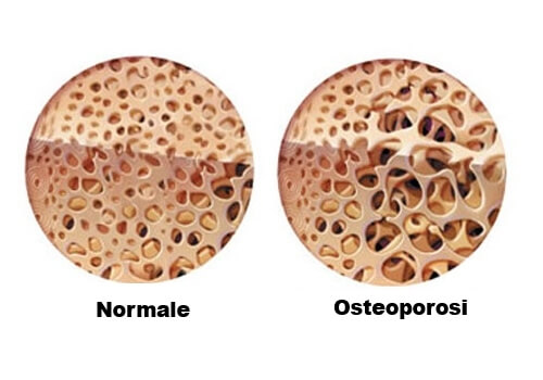 Osteopori causata dal trattamento del morbo di Crohn