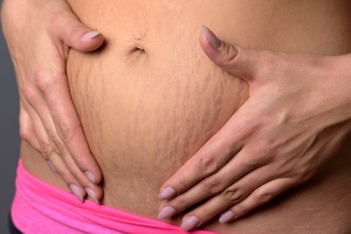 migliorare le smagliature migliorare le smagliature