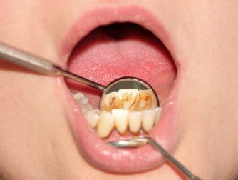 Come rimuovere il tartaro in modo naturale