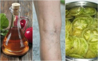 Aceto e pomodori verdi per combattere le varici