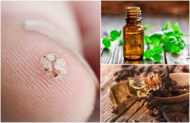 7 oli essenziali per rimuovere le verruche