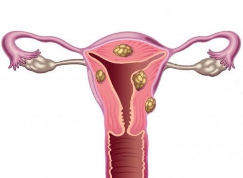 Mioma uterino