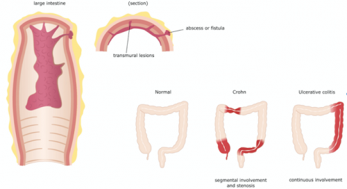 Trattamento del morbo di Crohn