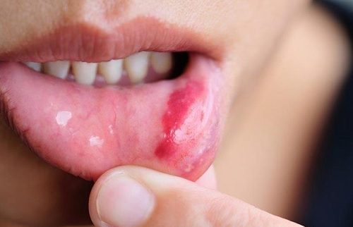 tumore alla lingua da papilloma virus)