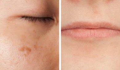 5 segni che indicano una carenza di vitamine