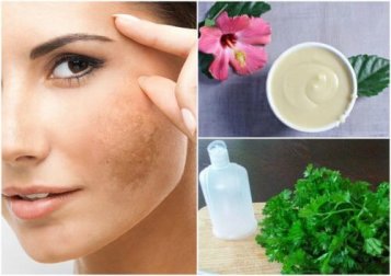 Melasma al viso come ridurlo grazie a 5 rimedi naturali