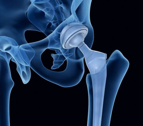 osteogenesi imperfetta l'anca