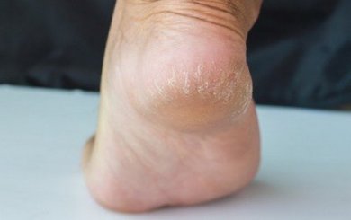 6 rimedi contro i talloni screpolati
