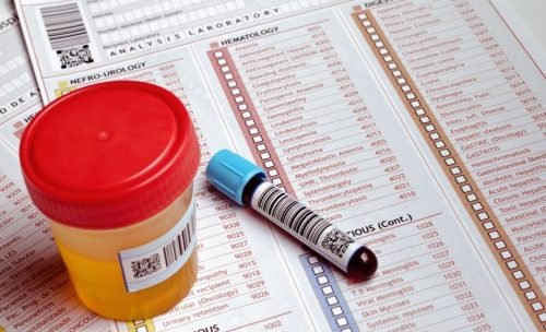 Sangue nelle urine tra i sintomi del tumore alla vescica