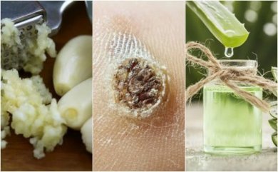 Trattare le verruche: i cinque migliori rimedi