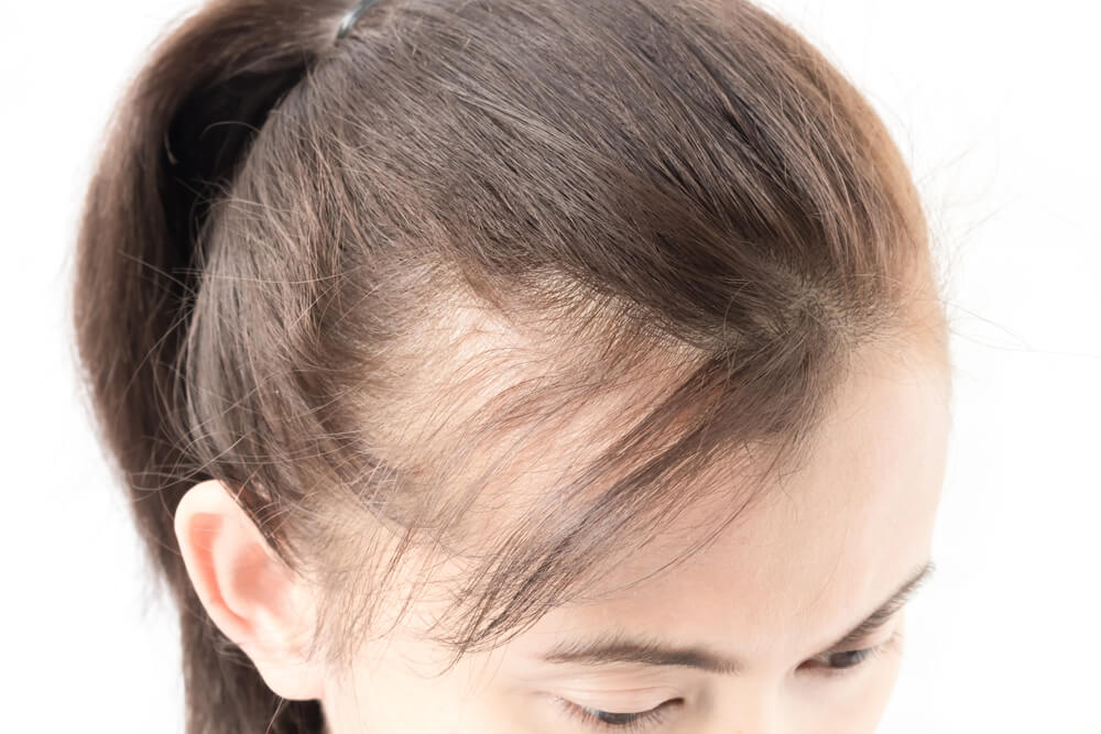 extension per coprire alopecia