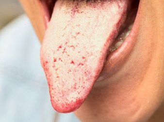 Il migliore trattamento della candidosi